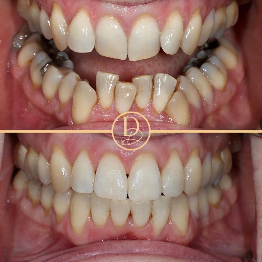 Ceramic Fixed Braces