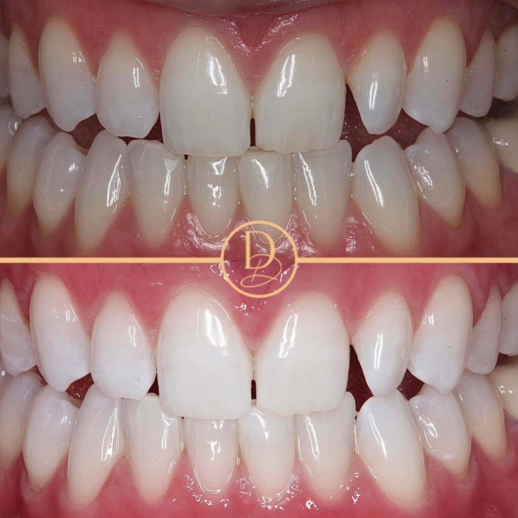 Teeth Whitening UK