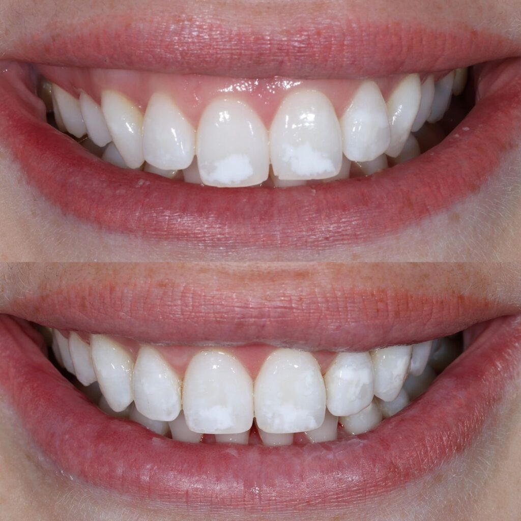 inviSalign UK