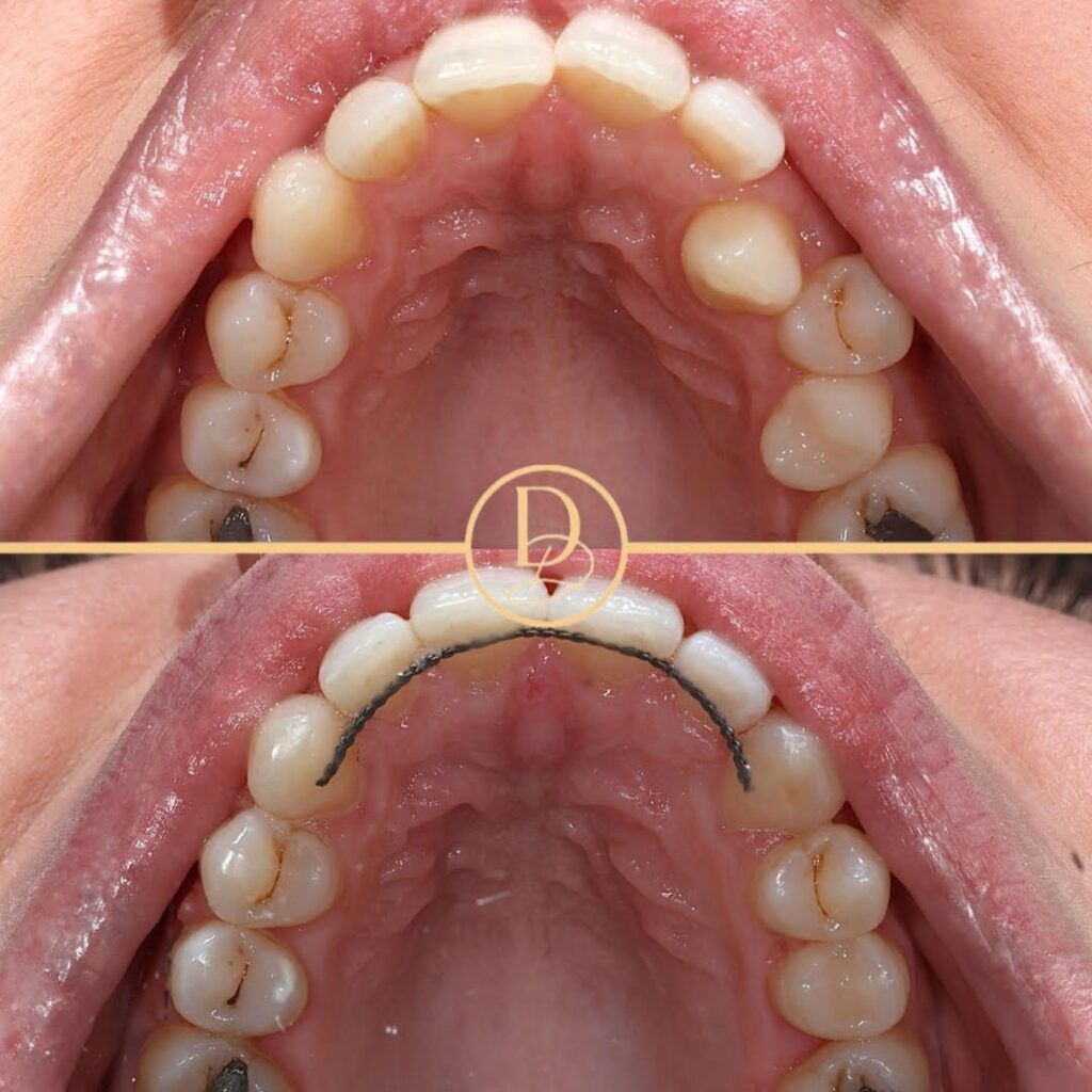 inviSalign®