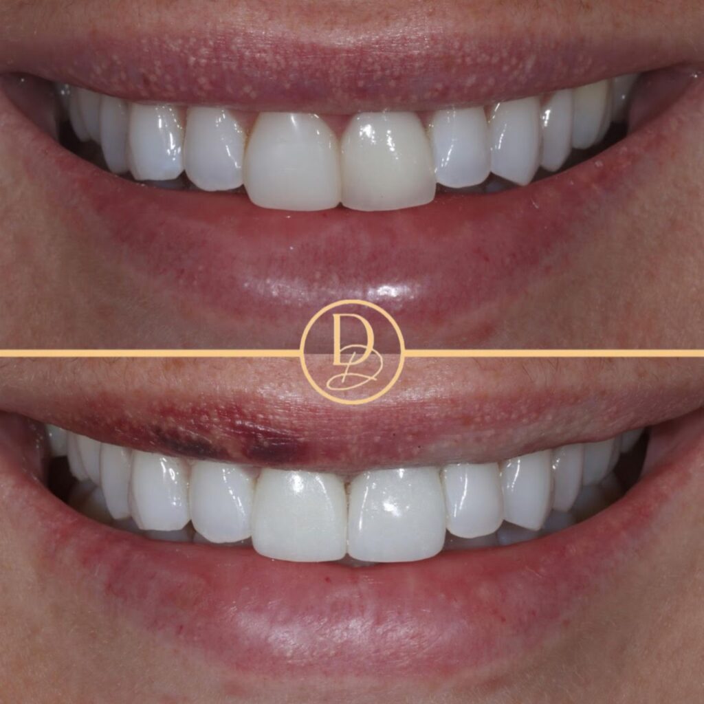 Porcelain Veneers