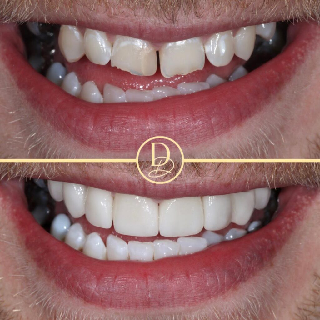 Porcelain Veneers