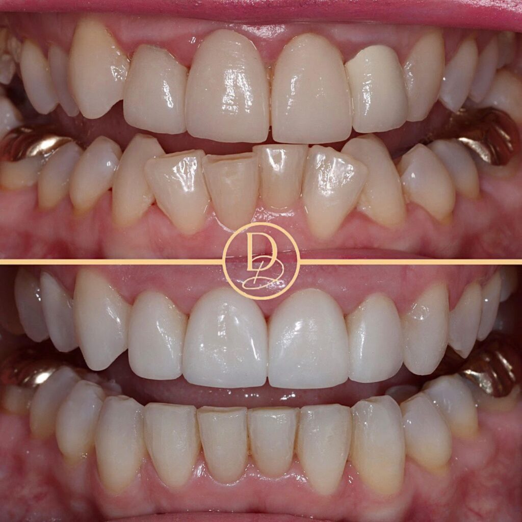 Porcelain Veneers